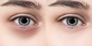 Dark eye circles treatment
